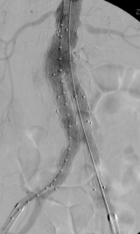 Implantation eines Stent-Grafts bei Aortenaneurysma