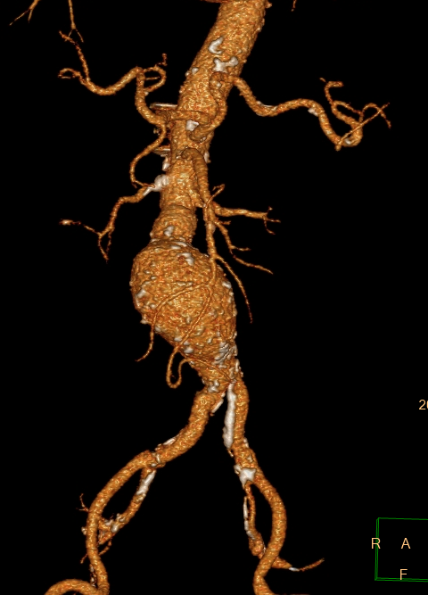 3D-Darstellung eines Aortenaneurysmas vor der Therapie