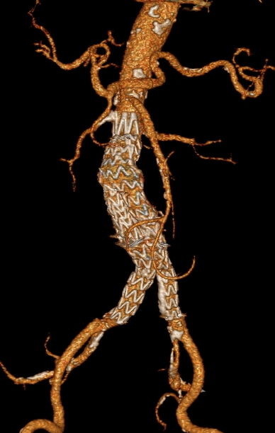 3D-Ergebnisdarstellung nach Ausschaltung des Aortenaneurysmas