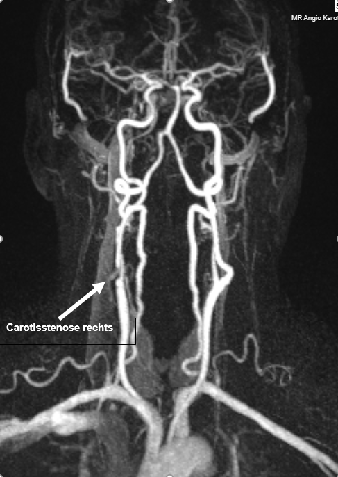 MR Angiografie
