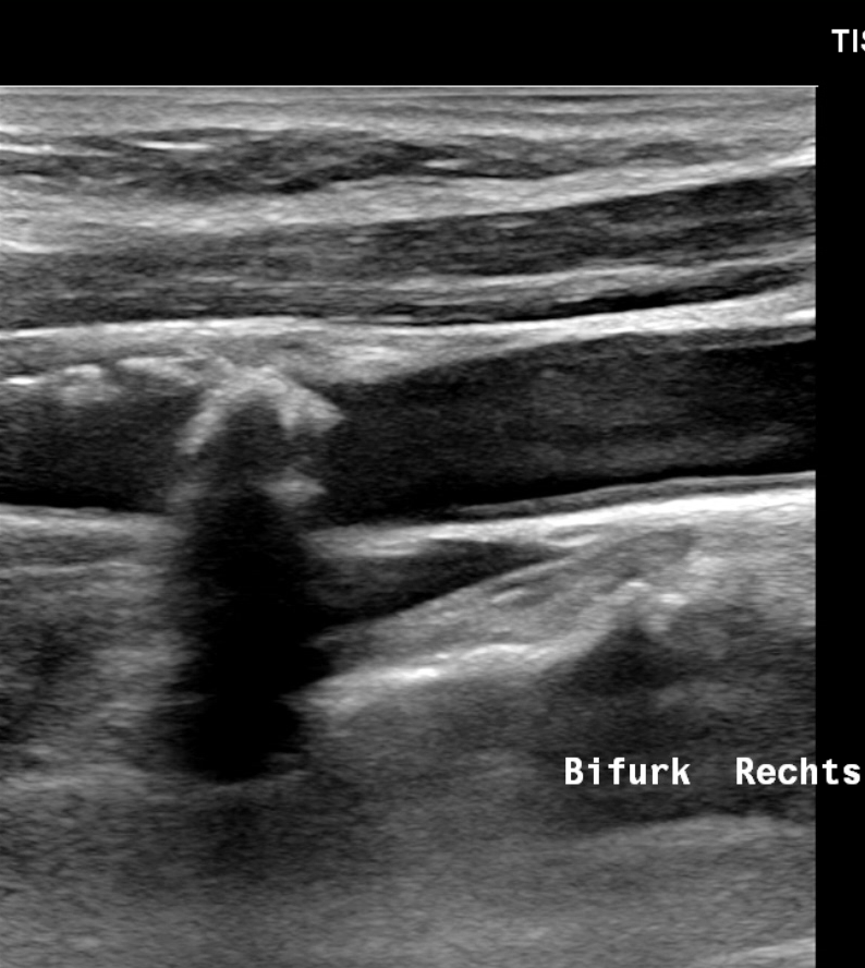 Farbduplex Sonografie - Bifurkation