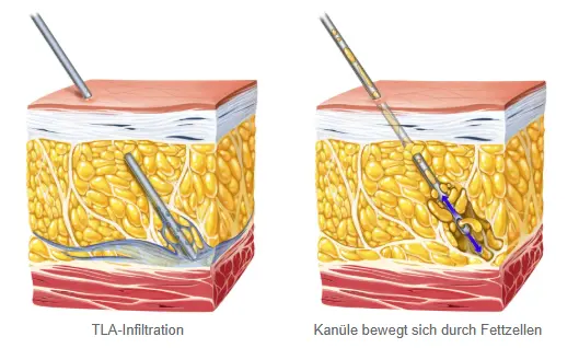 Power-Assistierte Liposuktion (PAL) - Vibrierende Kanüle im Fettgewebe