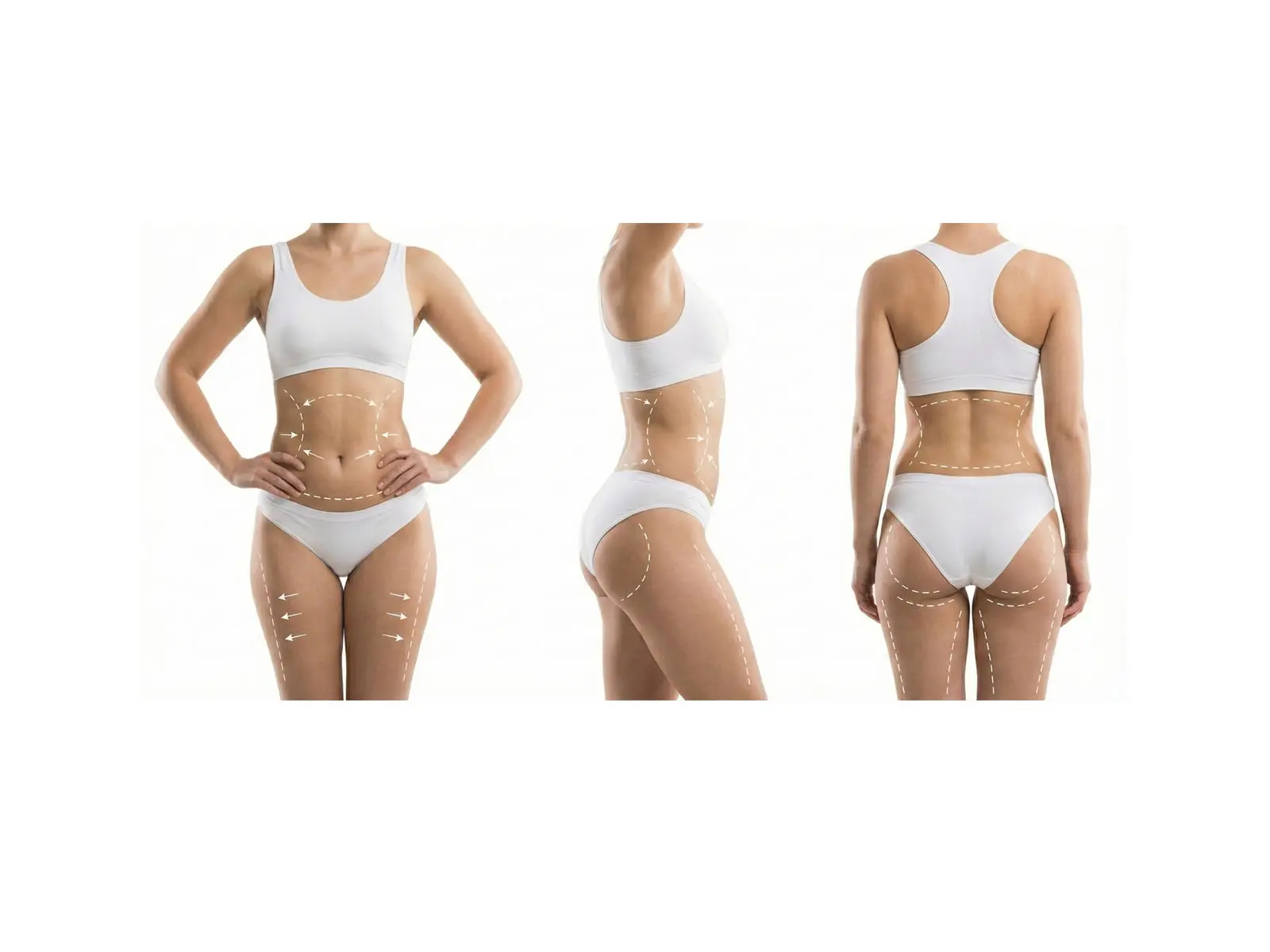 Liposuktion: markierte Areale zur Konturierung